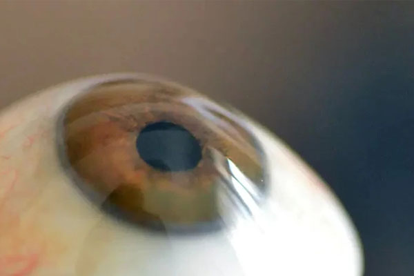 德国义眼师制作玻璃义眼怎么样